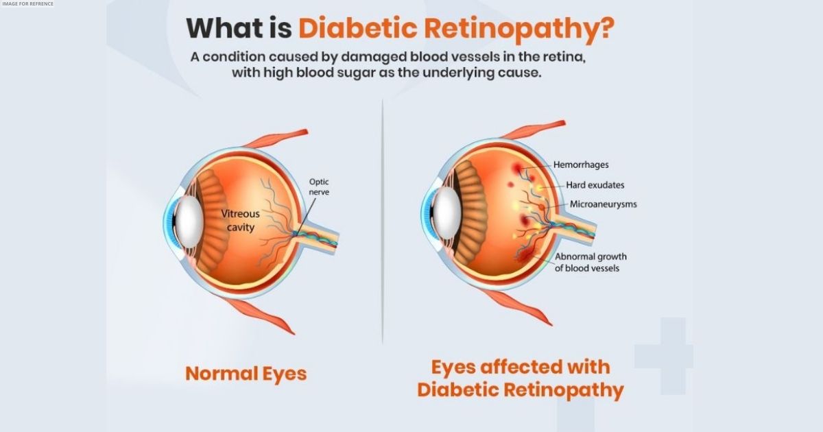 Can Diabetic Retinopathy Be Reversed?